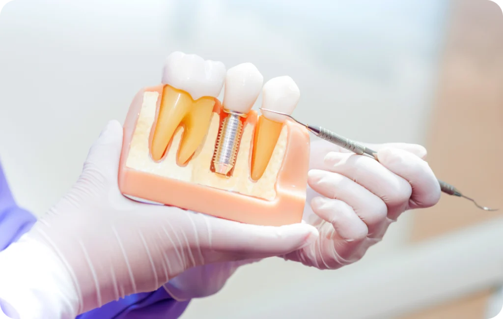 adobestock 320187109 1 adobestock 320187109 1 Implant Dentaire Apolline Dental Care | Cabinet Dentaire Spécialisé